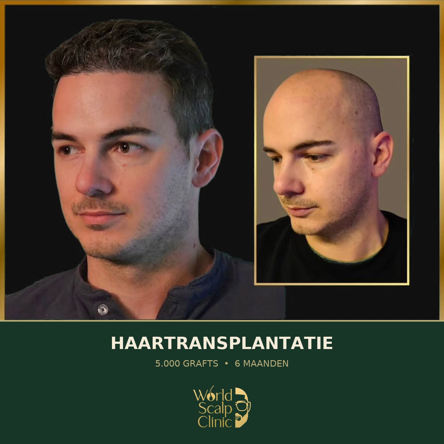 Voor & na haartransplantatie 1