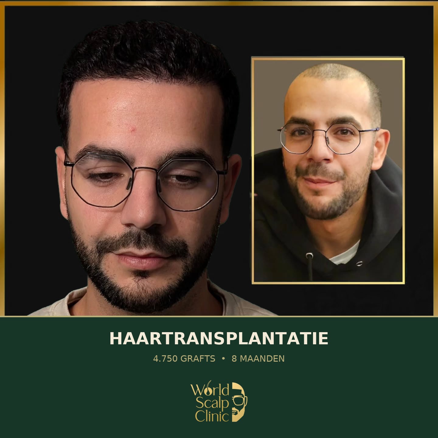 Voor & na haartransplantatie 2