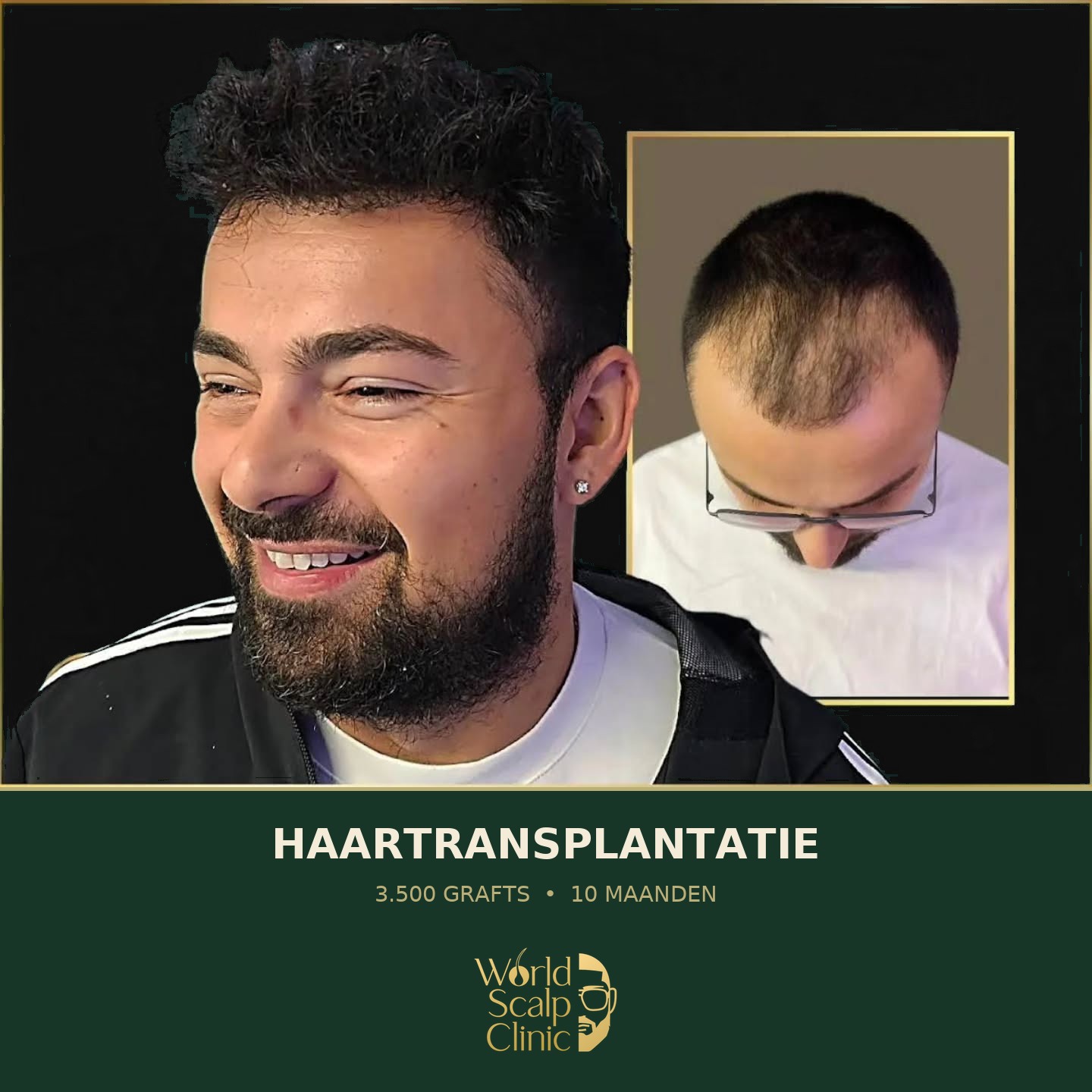 Voor & na haartransplantatie 3