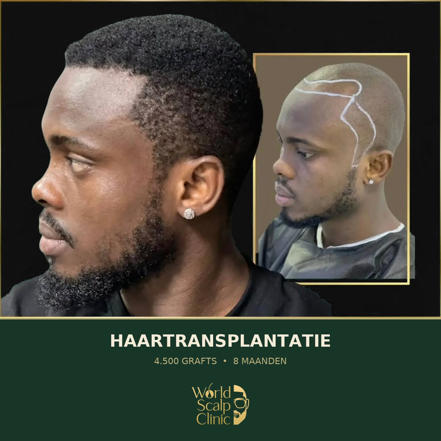 Voor & na haartransplantatie 4