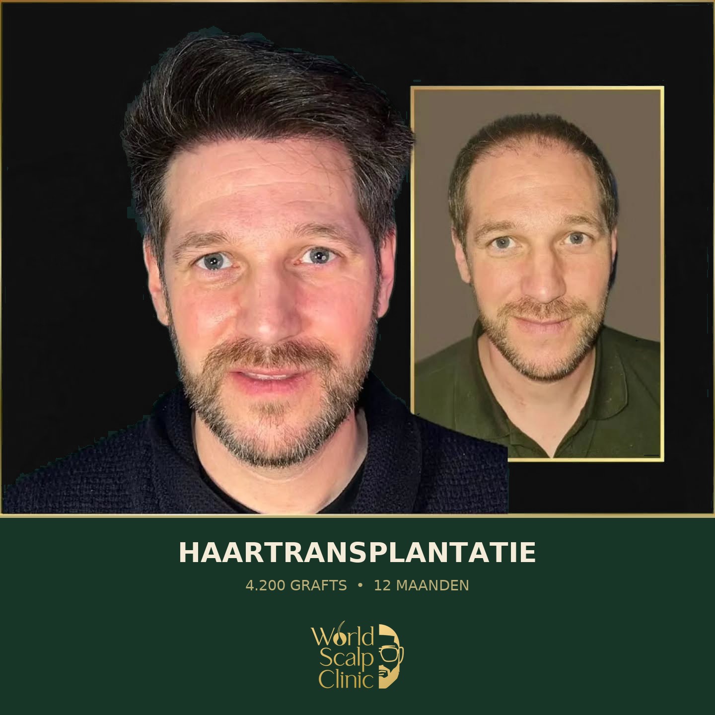 Voor & na haartransplantatie 5