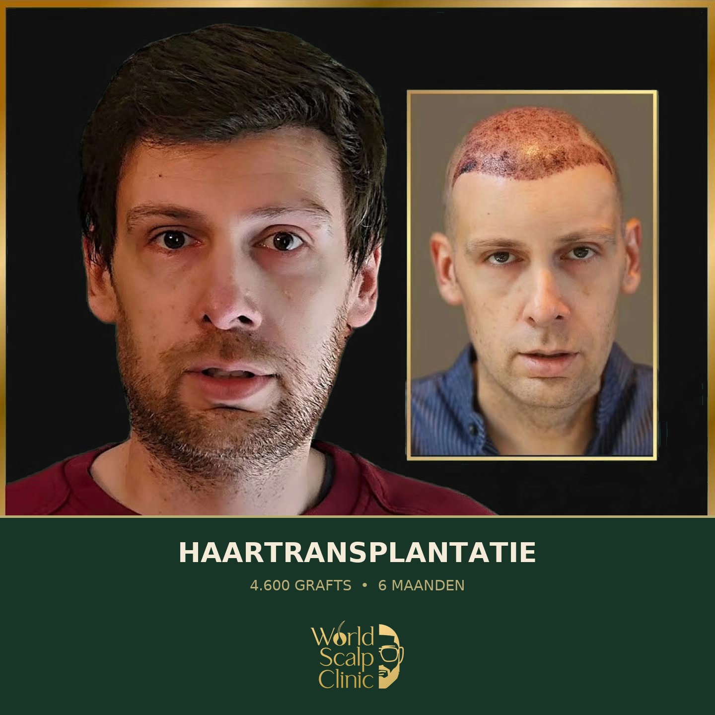 Voor & na haartransplantatie 6